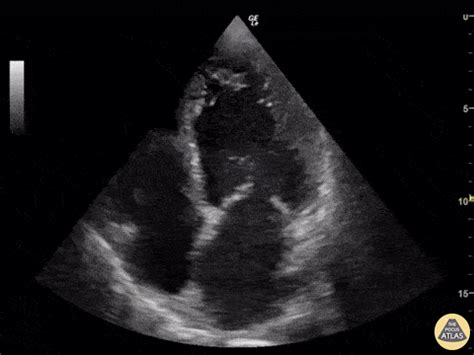 rivaroxaban lv thrombus|apixaban vs warfarin lv thrombus.